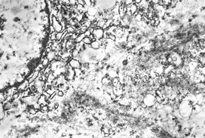 F,45y. | myo-fibrosarcoma - thigh